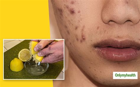 How To Use Lemon To Remove Pimples And Dark Spots Onlymyhealth