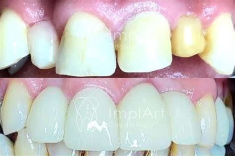 Agenesia Coroas Emax Antes E Depois Kb Implart