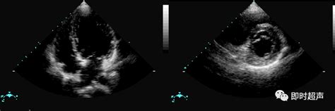 心脏瓣膜病超声诊断二尖瓣