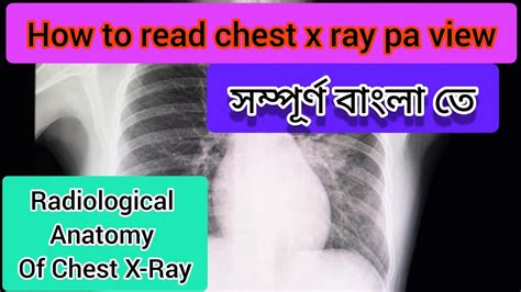 How To Read Chest X Ray Pa View Chest X Ray Radiological Anatomy Youtube