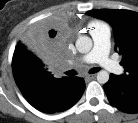 Spectrum Of Ct Findings In Thoracic Extranodal Non Hodgkin Lymphoma Radiographics