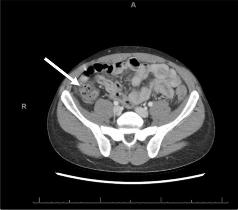 This Figure Shows An Axial Computed Tomography Scan With Contrast Of