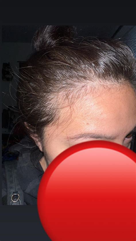 Oral Minoxidil 2 5mg 2x A Day More Info In Comments R Femalehairloss