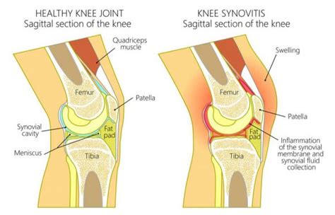 Fluid In Knee Symptoms Causes Treatment By Knee Braces