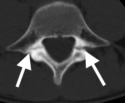 Surgical Repair of Pars Interarticularis Fractures | Spine Surgeon ...