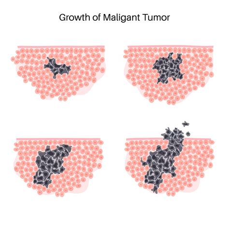 Quanto Tempo Um Tumor Maligno Demora Para Crescer - Ilustração em vetor isolada de tumor maligno em tecido saudável ...
