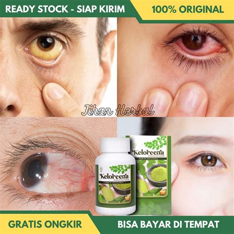 Jual Obat Mata Kuning Pemutih Mata Kuning Obat Mata Merah Iritasi Dan