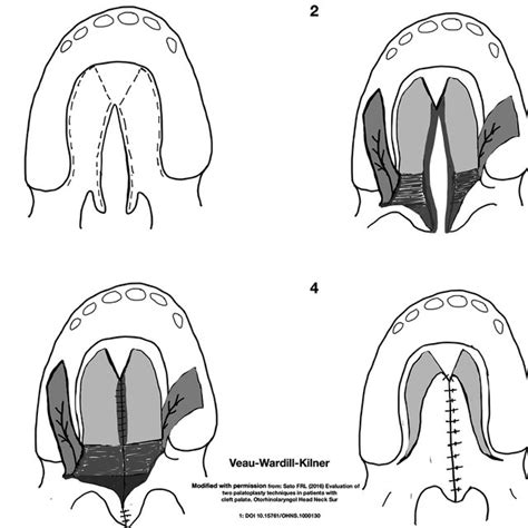 Bardach S Two Flap Palatoplasty Technique Drawn By The First Author