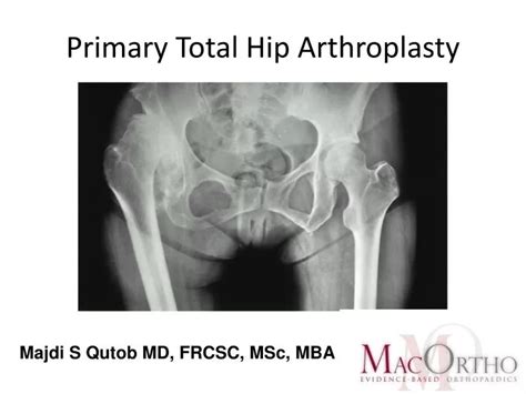 Ppt Primary Total Hip Arthroplasty Powerpoint Presentation Free Download Id 3040109