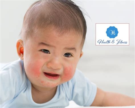 Baby Acne Causes And The Best Treatment Tips