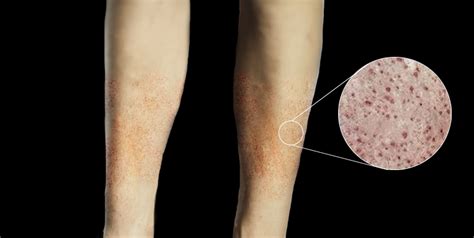 Ecchymosis Vs Petechiae