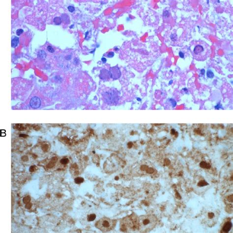 Hematoxylin And Eosin Stain He Stain Panel A Of Our Patients Liver Download Scientific