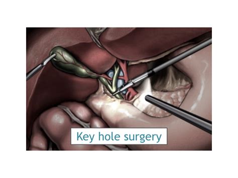 Gallbladder Stones Treatment Clinic Laparoscopic Gallbladder Surgery Laparoscopic