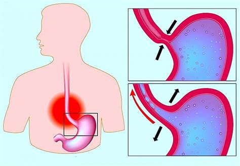 Ösophagitis Reflux Hiatushernie Gastritis Entzündung Symptome Diät