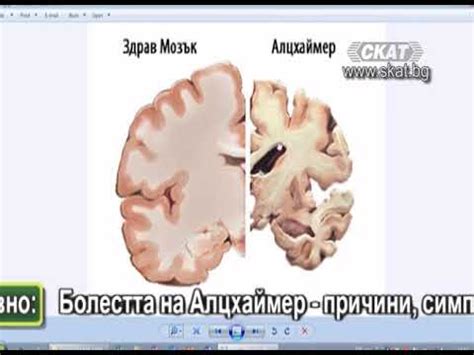 Болест на Алцхаймер: симптоми, причини и лечение - Наука - 2024