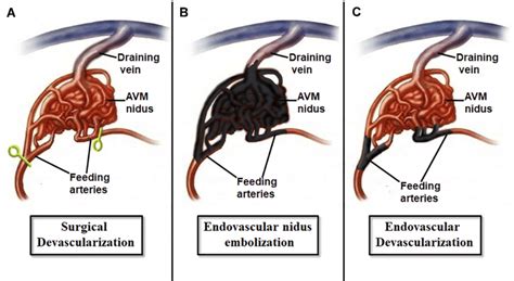 Schematic Drawing Demonstrating Various Approaches To Avm A Download Scientific Diagram