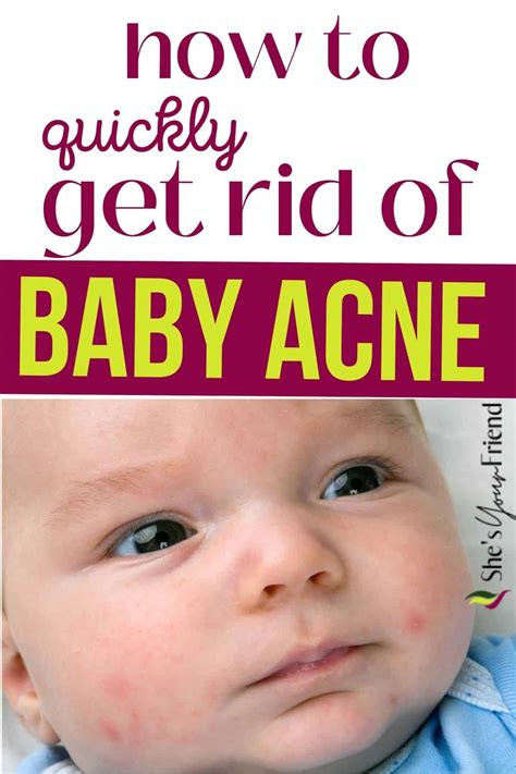 how to help baby acne 1