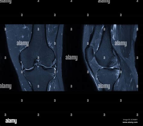 Knee mri coronal view hi-res stock photography and images - Alamy