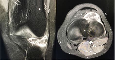 High Resolution Ultrasonography Diagnosis Of Meniscal Cyst From Lateral