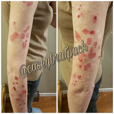 Autoimmune Disease Rash 26 Photos That Show How Autoimmune Disease Images