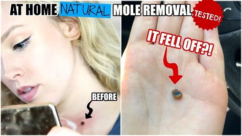 Testing a natural at home mole removal cream – Artofit