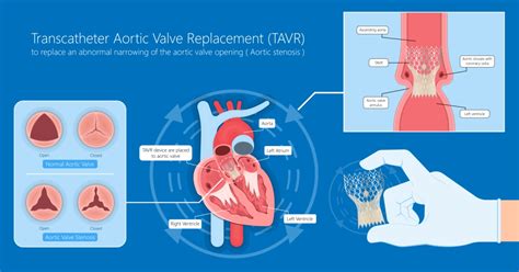 Best Doctors & Hospitals in India for Aortic Valve Regurgitation Treatment