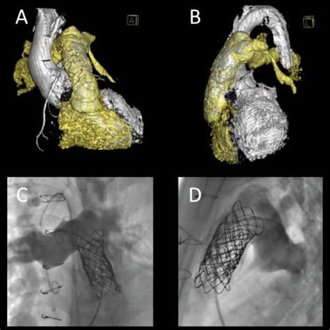 The Melody Transcatheter Pulmonary Valve Medtronic Minneapolis Minn