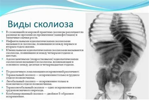 Нужно ли носить при сколиозе корсет – Как выбрать корсет для спины при ...