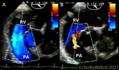 Echocardiography Online Analysis Of Noninvasive Hemodynamics