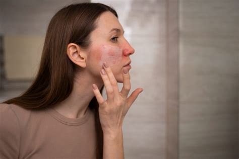 Rosacea Apa Penyebabnya Linisehat