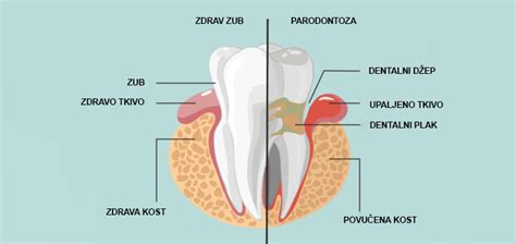 Curasept Serbia Parodontopatija Zbog čega se javlja i kako se leči