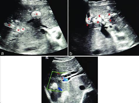 Longitudinal Ultrasonography Image Demonstrating Multiple Echogenic