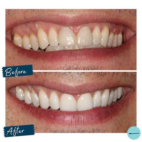 Teeth Whitening Your Guide To A Brighter And Happier Smile Teeth