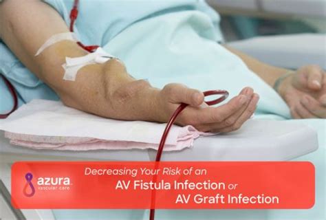 What Does a Healthy AV Fistula Look Like? | Azura Vascular Care