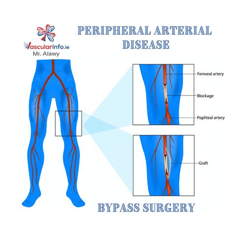 Angioplasty Vascular Info