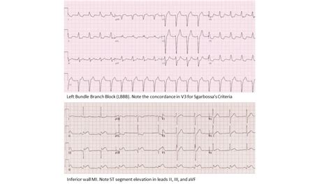 Lateral Wall Myocardial Infarction Statpearls Ncbi Bookshelf