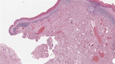 Balanitis Xerotica Obliterans Histology