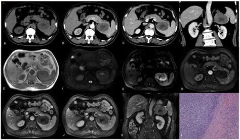 This Patient Was Diagnosed With Psl At Splenectomy A A Ct Plain Scan