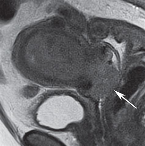 Icd 10 Code For Carcinoma Of Uterine Cervix