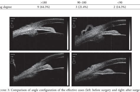 Figure 3 From Argon Laser Peripheral Iridoplasty And Argon Laser