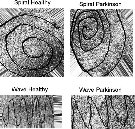 Table 1 From Parkinsons Disease Detection From Spiral And Wave