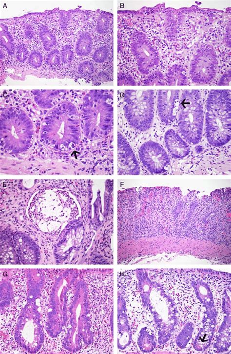 Colonic Biopsy Samples From Patients With Idelalisib Related Mucosal