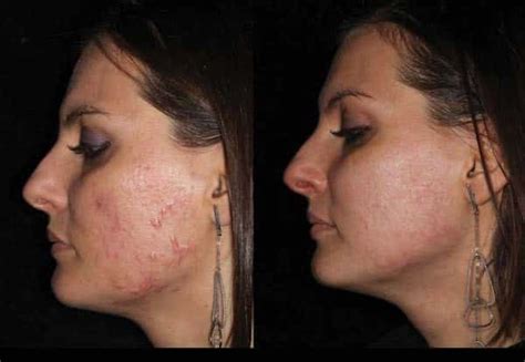 Dermatologist With Acne Patient