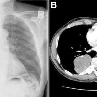 A Chest Roentgenogram And B Computed Tomographic Scan Showing Large