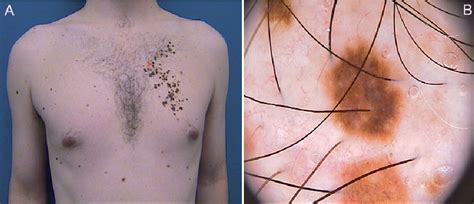 Figure 1 From Primary Cutaneous Melanoma Arising In Agminated