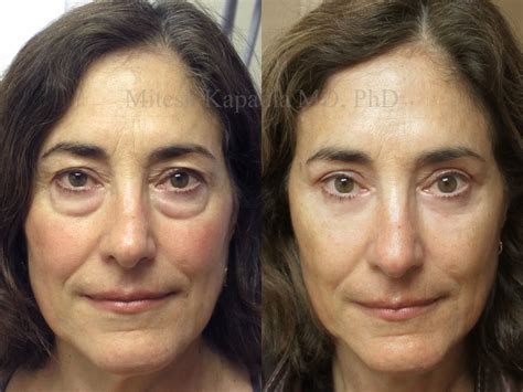 Lower Blepharoplasty Procedure