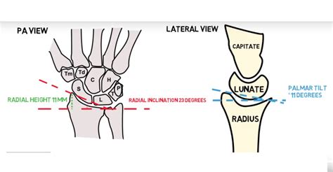 Normal Distal Radius Angles — OrthopaedicPrinciples.com