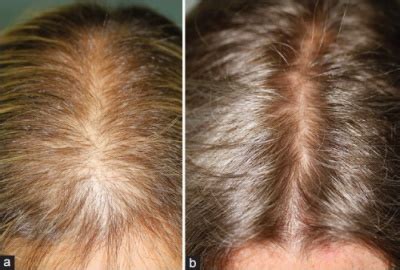 12 Things All Women Should Know Before Using Finasteride for Hair Loss