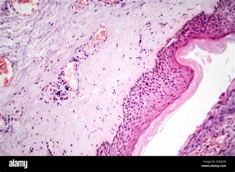 Photomicrograph Of Basal Cell Carcinoma Displaying Malignant Basal Cells Typical Of The Most