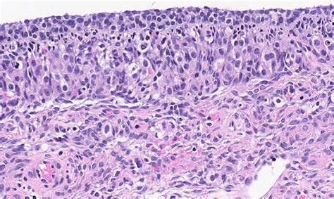 Pathology Outlines Follicle Cyst